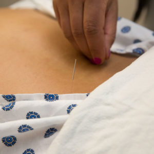 acupuncture closeup